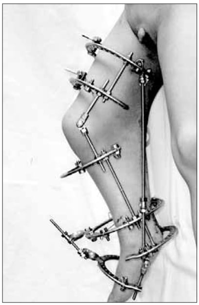 Ilizarov external fixator applied across a popliteal pterygium knee contracture
