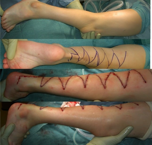 Operative sequence showing ischiocalcaneal band release and zig-zag skin closure