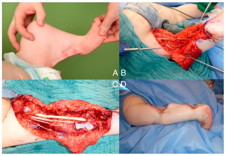 Intraoperative photographs of surgical release of a popliteal pterygium, showing the fibrous cord, neurovascular dissection, nerve/vessel grafting, and final Z-plasty closure