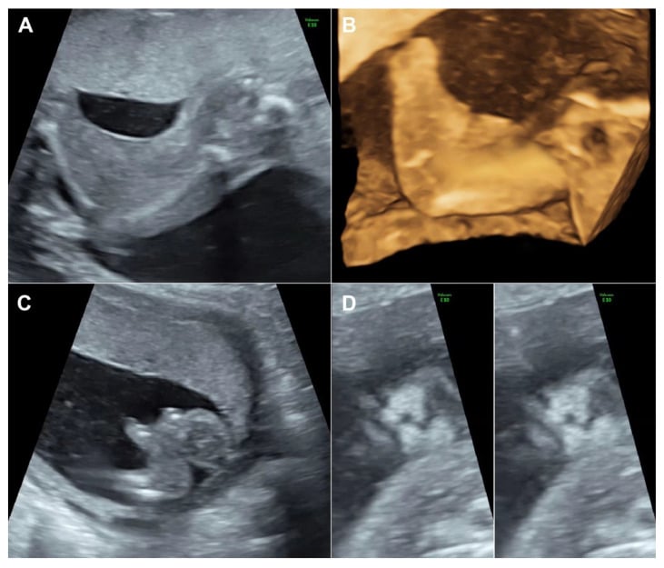 Prenatal ultrasound panels showing popliteal webbing, ectrodactyly and upper-lip grooves