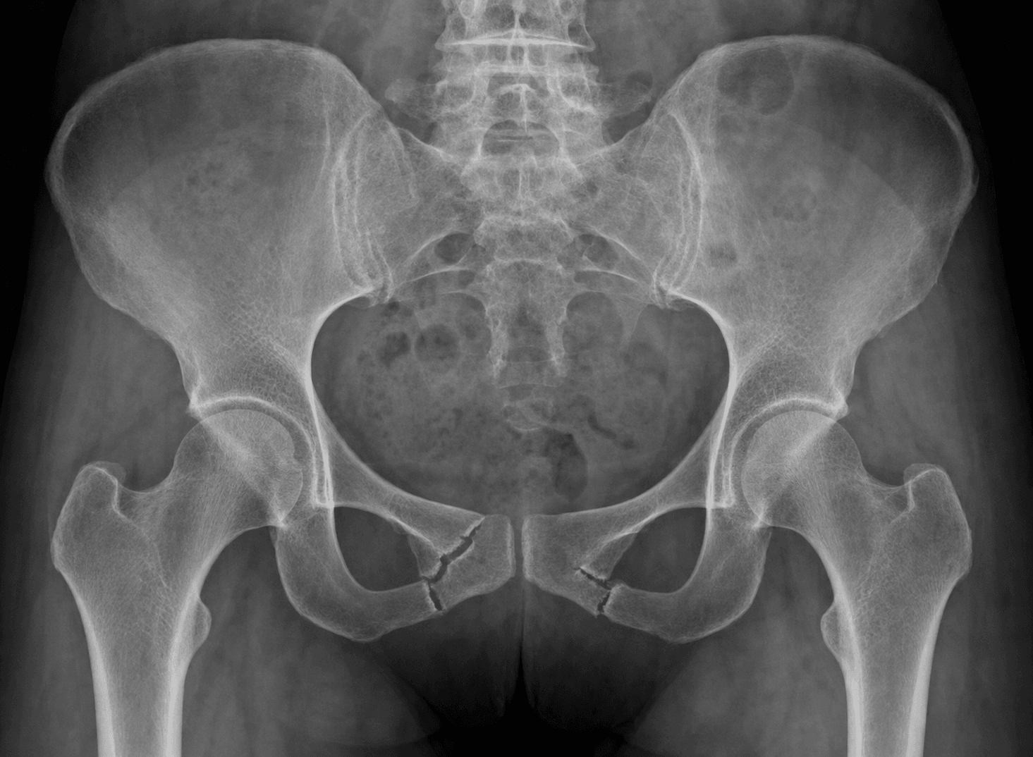 AP pelvis radiograph showing fractures of the pubic rami.
