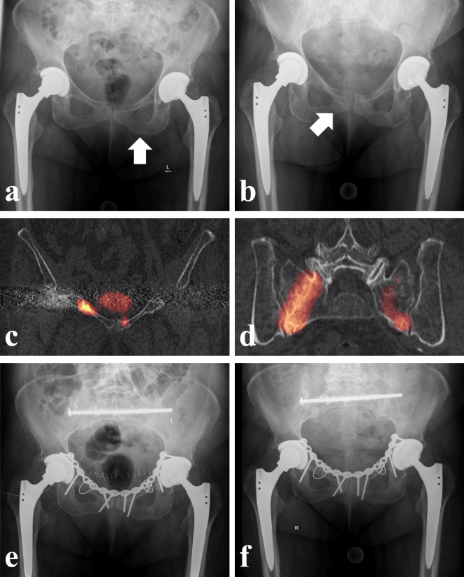 Serial radiographs, CT with bone scan and postoperative radiographs showing progression from unilateral ramus fracture to bilateral rami and sacral fractures