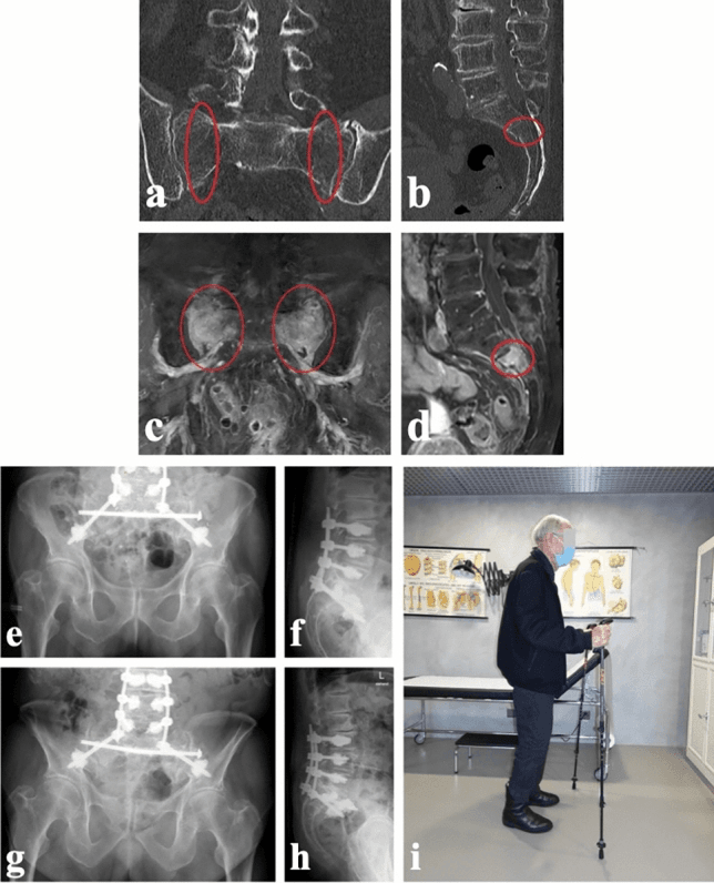 CT MRI postoperative radiographs and mobilisation after FFP IV H-shaped sacral fracture