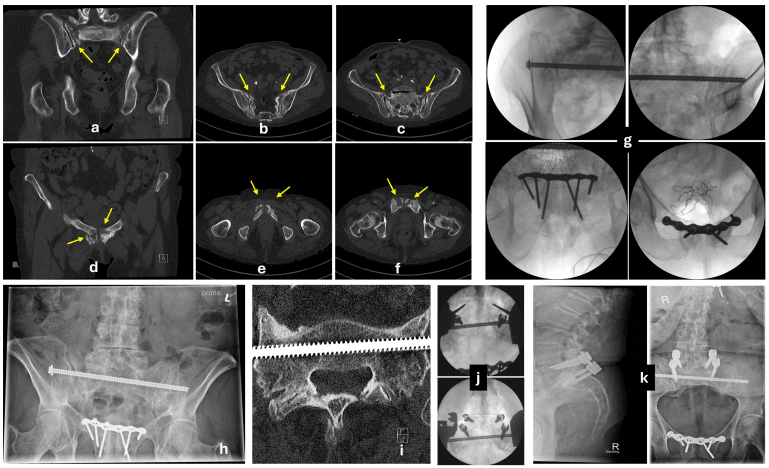 CT, intraoperative fluoroscopy and postoperative imaging of H-type fragility fracture fixation with posterior screws and an anterior plate