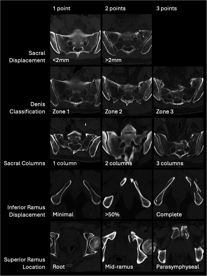 CT examples of LC-1 sacral and pubic-ramus fracture features used in a validated scoring system