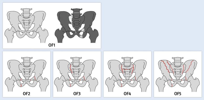 Osteoporotic-fracture-of-the-pelvis classification diagram, panels OF1 to OF5, from marrow oedema through bilateral posterior injury and complex patterns