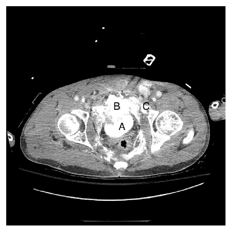 Axial CT of an open-book pelvic fracture showing a contrast-filled bladder (A), anterior contrast extravasation (B) and a pubic ramus fracture (C)