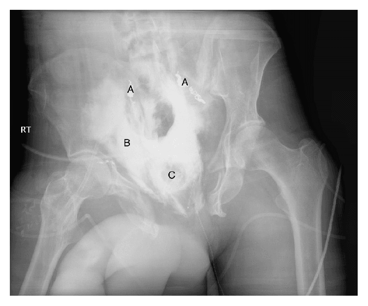 Cystogram after pelvic fracture showing extravasated contrast (B) outside the bladder around a suprapubic tube balloon (C)