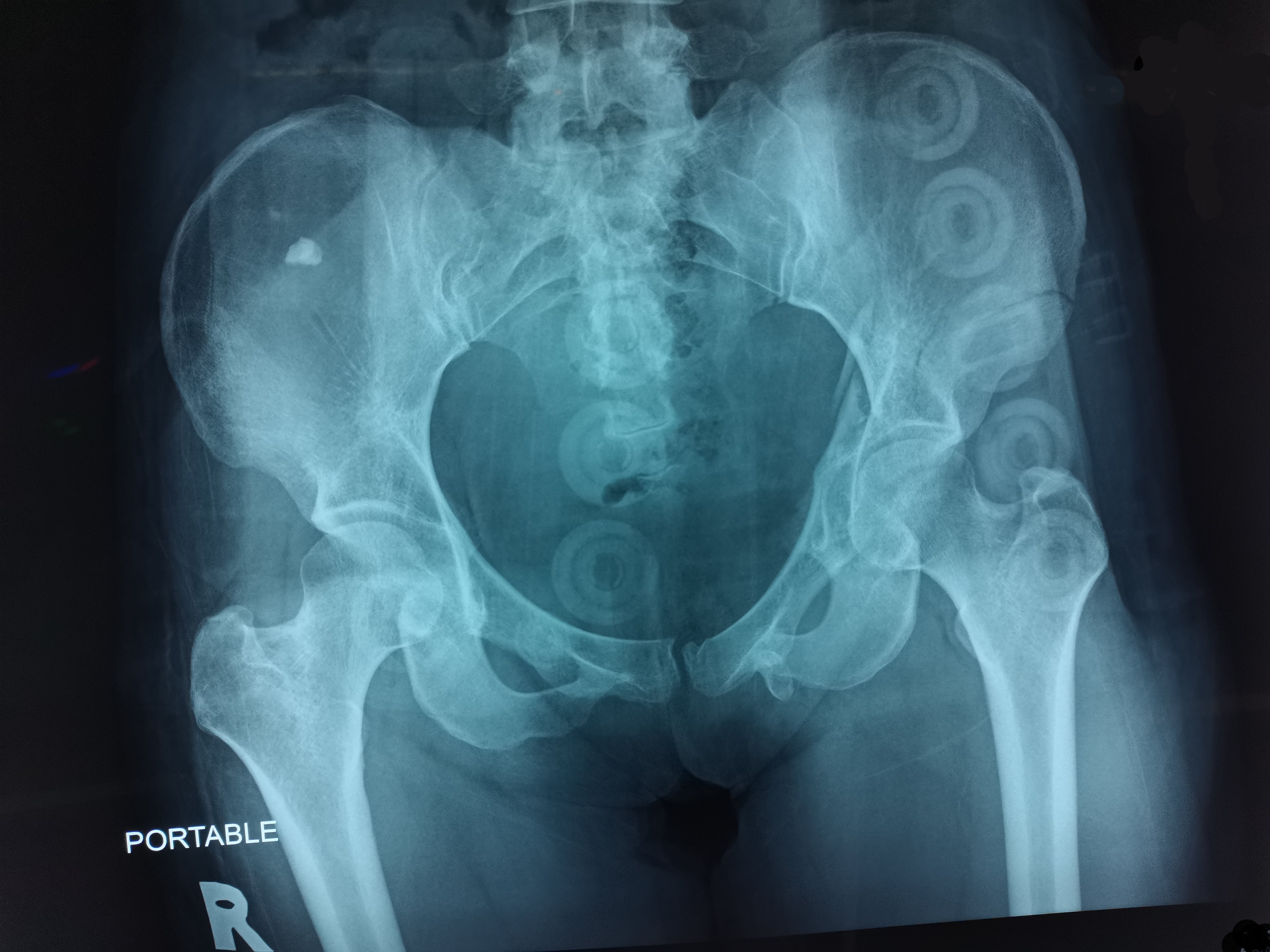 Portable AP pelvis radiograph showing a fracture of the left inferior pubic ramus