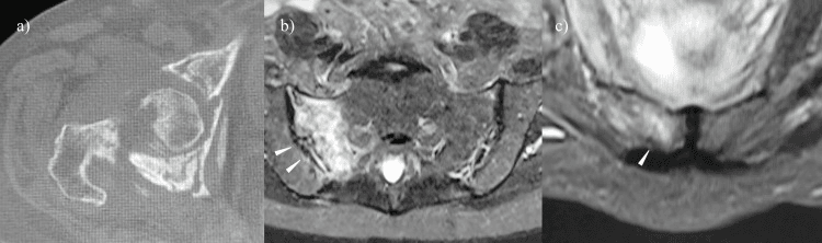 CT and STIR MRI showing a pubic ramus fracture with occult sacral-ala injury