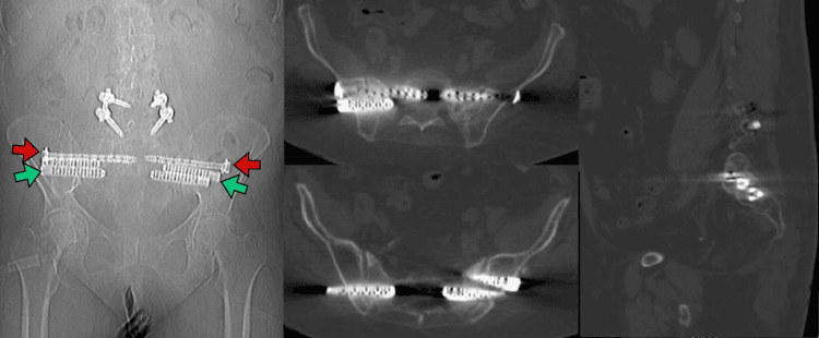Pelvic radiograph and CT showing bilateral trans-sacral iliac and sacroiliac screw fixation