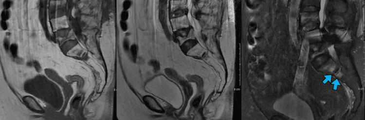 Sagittal T1 T2 and STIR MRI showing sacral insufficiency fracture marrow oedema