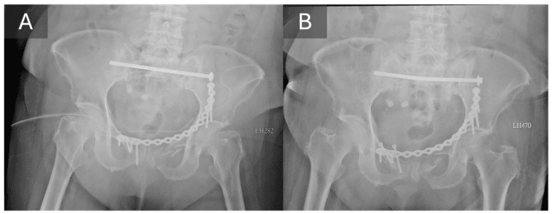 Immediate and one-month pelvic radiographs showing transiliac-transsacral screw loosening bending and back-out