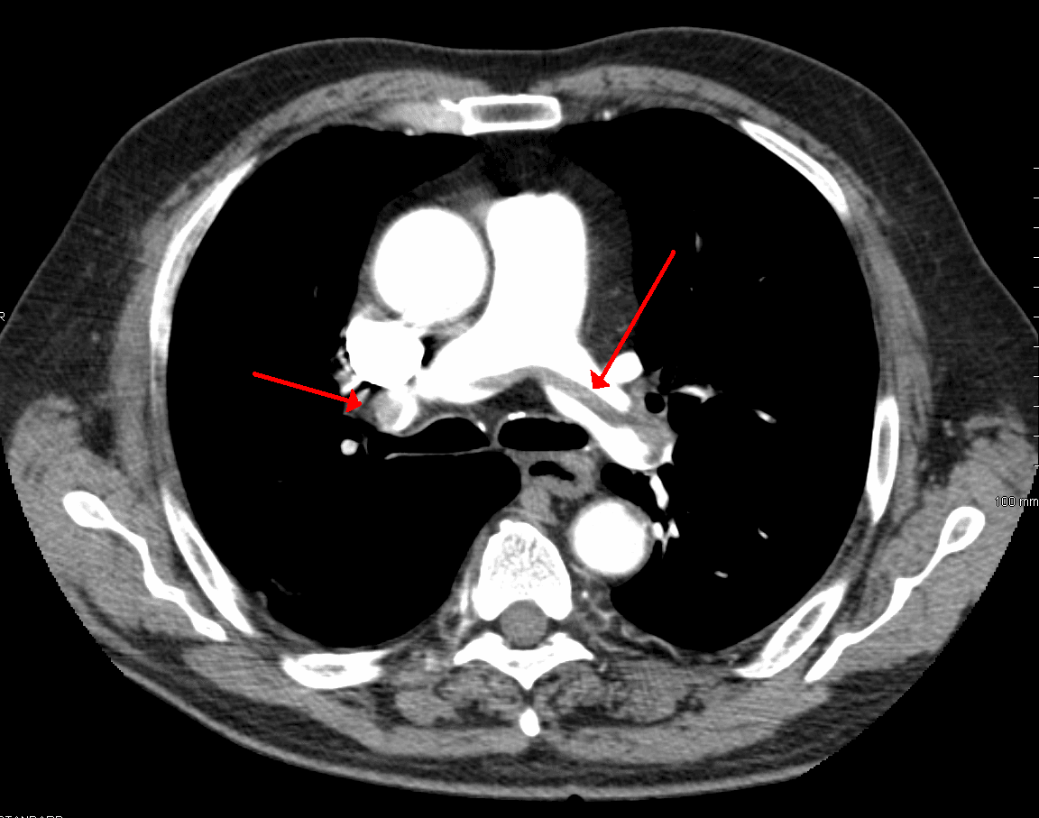 Axial CT pulmonary angiogram showing a saddle embolus filling the pulmonary artery bifurcation.