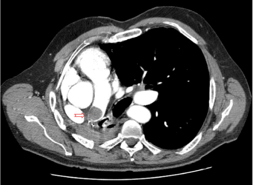 Contrast-enhanced CT showing a filling defect in the right pulmonary artery stump