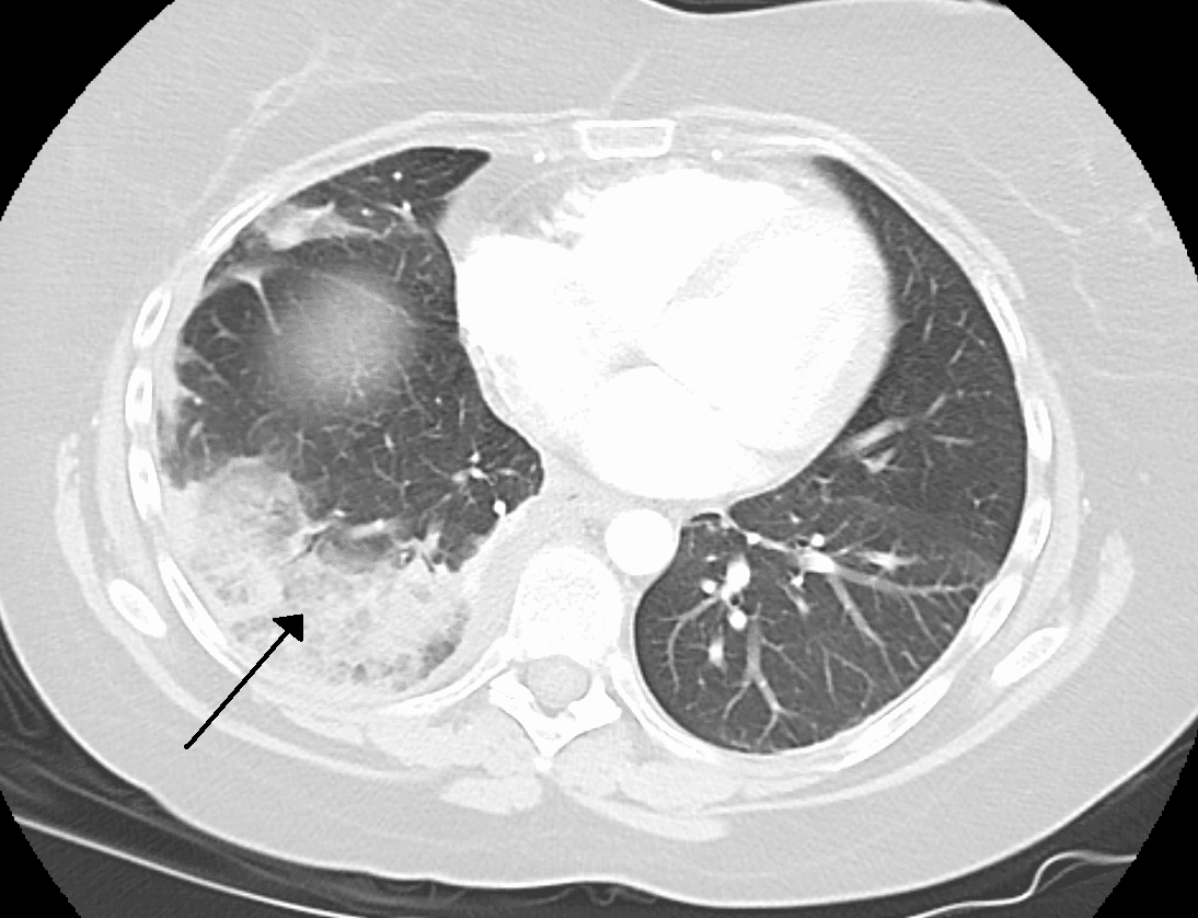 Axial CT showing a peripheral wedge-shaped pulmonary infarction marked by an arrow