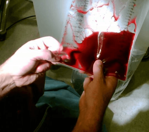 Collection bag containing thrombus evacuated during percutaneous pulmonary thrombectomy
