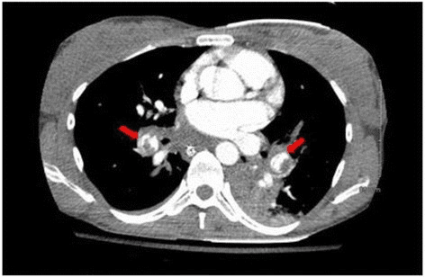 Contrast-enhanced axial chest CT showing bilateral near-occlusive pulmonary emboli marked by red arrows