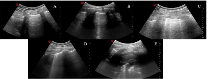 Point-of-care lung ultrasound scoring criteria for perioperative pulmonary assessment