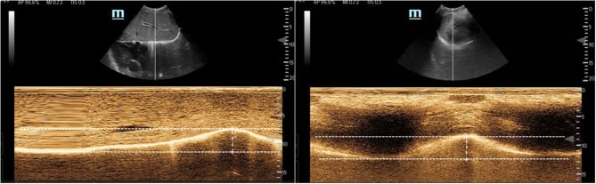 M-mode ultrasound measurement of diaphragmatic mobility and excursion