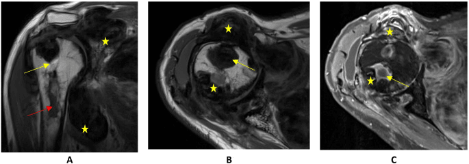 Shoulder MRI showing aggressive TGCT with bone destruction and extra-articular extension
