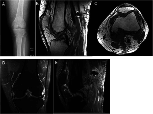 Postoperative knee radiograph (A) and four MRI images (B to E) after combined synovectomy for diffuse TGCT