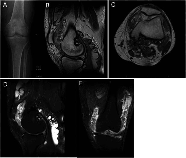 Pretreatment knee radiograph (A) and four MRI images (B to E) of diffuse TGCT with femoral condyle osteolysis