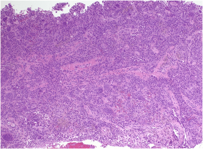 Histology of hypercellular diffuse tenosynovial giant cell tumour