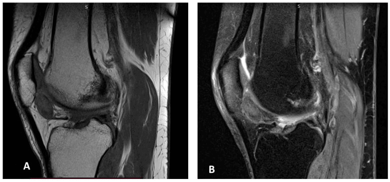 Two sagittal knee MRI images, A and B, showing low-signal foci in a localized TGCT