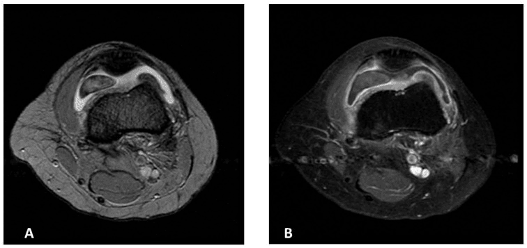 Two axial knee MRI images, A and B, of a localized intra-articular tenosynovial giant cell tumour