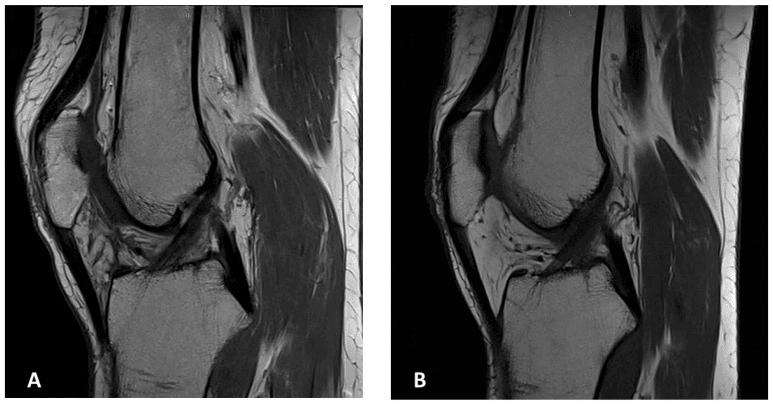 Two sagittal knee MRI images at follow-up without recurrent localized TGCT