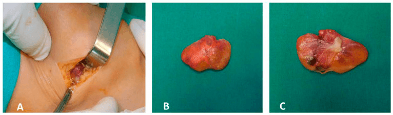 Three panels showing operative excision of a localized knee TGCT (A) and the gross specimen (B, C)