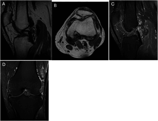 Multiplanar MRI showing partial response of diffuse TGCT to pexidartinib