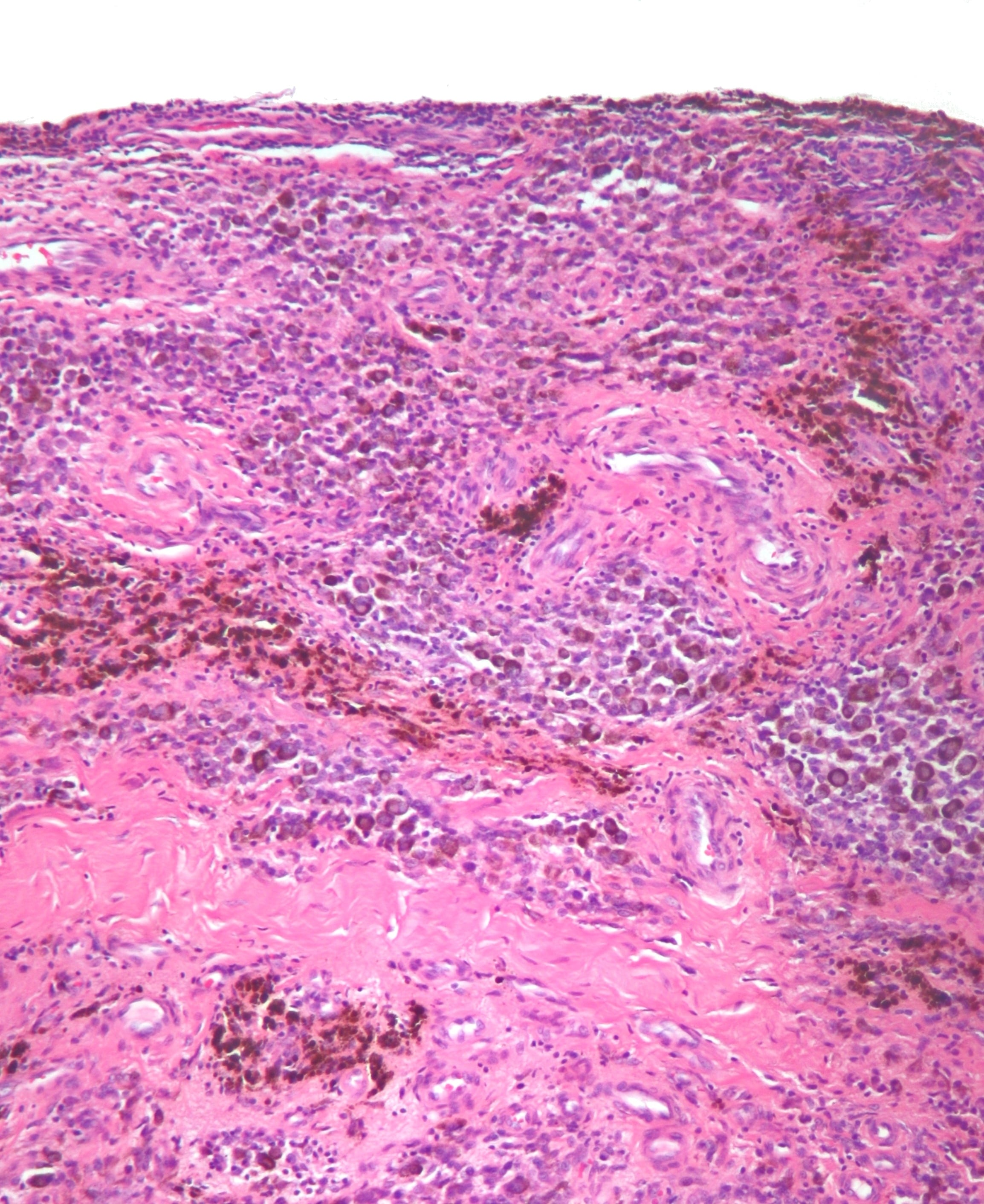 High-power H&E micrograph of pigmented villonodular synovitis showing a cellular synovial proliferation with multinucleated giant cells and abundant golden-brown hemosiderin pigment.