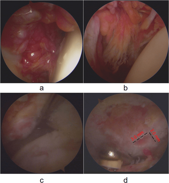 Four arthroscopic shoulder views of PVNS showing villous synovium and a focal bone erosion marked with 3.0 mm and 2.0 mm measurements