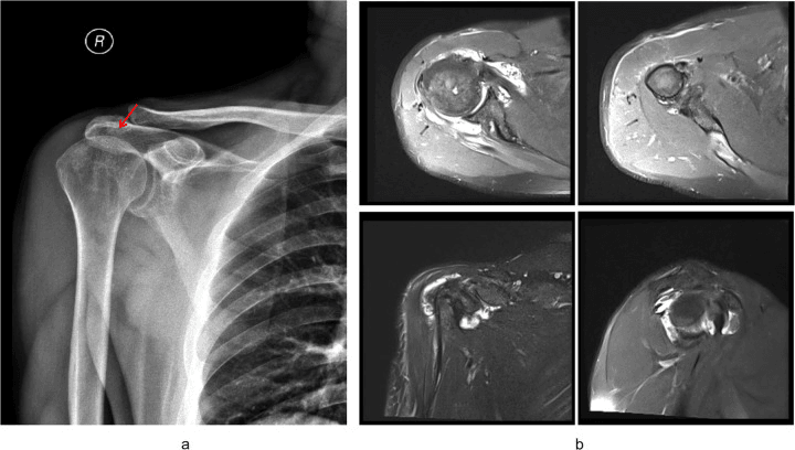 Right shoulder radiograph with an arrow at acromial cortical irregularity (a) and four MRI images of diffuse PVNS with erosion (b)