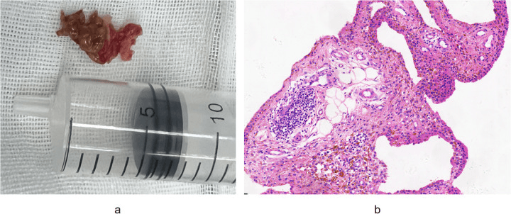 Panel a, gross brown-yellow villonodular shoulder synovium beside a syringe; panel b, H&E histology showing synovial hyperplasia with hemosiderin