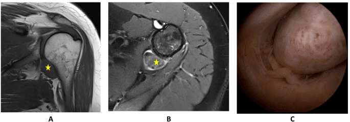 Two shoulder MRI images with a starred localized TGCT mass (A, B) and an arthroscopic view of the mass (C)