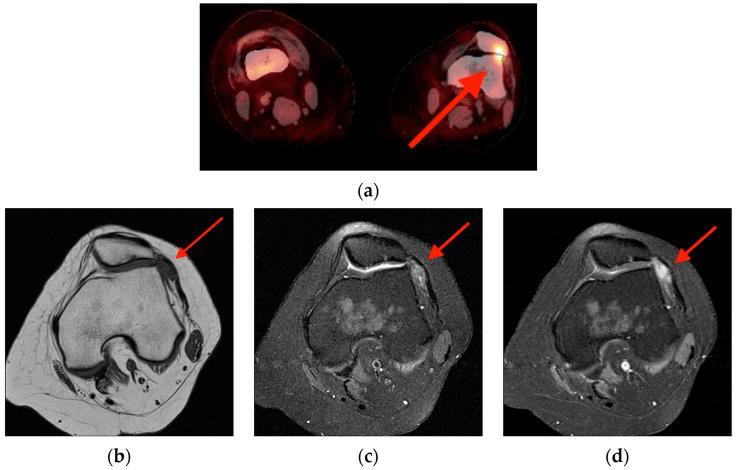 FDG PET/CT image and three axial knee MRI images, arrows marking a tenosynovial giant cell tumour