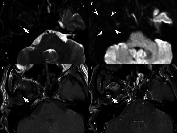Four-panel TMJ MRI with arrows and arrowheads marking hypointense TGCT and hemosiderin blooming