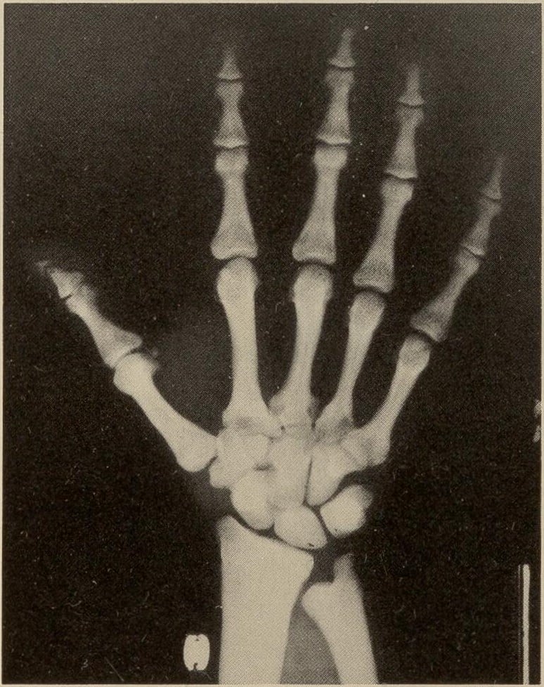 Hand radiograph in pyknodysostosis showing acroosteolysis of the thumb's terminal phalanx