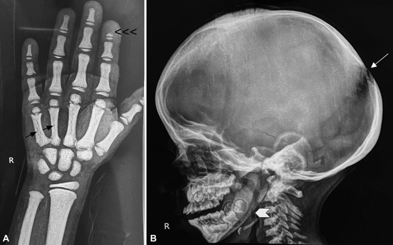 PA hand radiograph demonstrating osteosclerosis and acro-osteolysis in pyknodysostosis