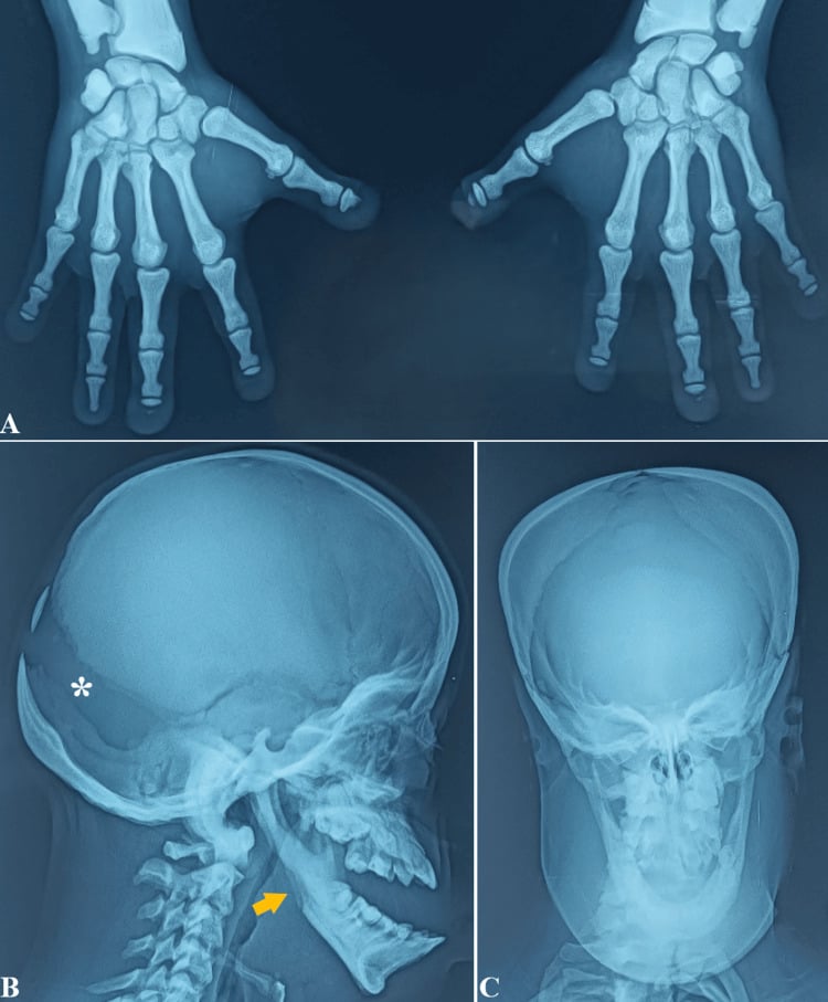Panel of pycnodysostosis films: acro-osteolysis of the fingertips, a sclerotic skull with Wormian bones, and an obtuse mandibular angle.