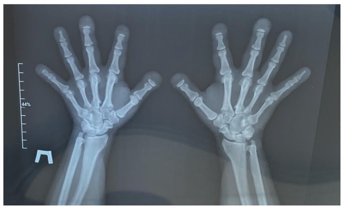 Radiograph of both hands with a scale bar, showing resorbed terminal tufts, short tubular bones and preserved joint spaces