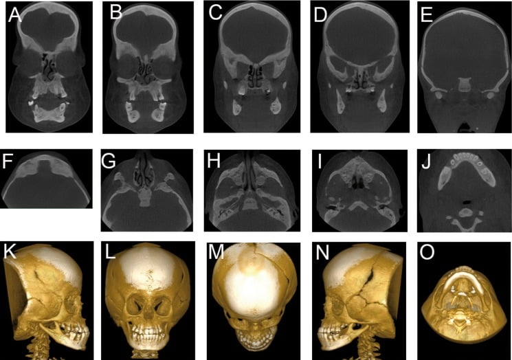 Craniofacial CT in fifteen panels: coronal slices A to E, axial slices F to J and three-dimensional surface reconstructions K to O showing wide cranial sutures