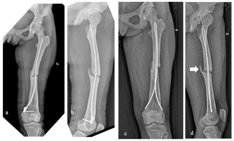 Four femoral radiographs, a to d, marked SN: a mid-shaft fracture with an intramedullary nail, then flexible nails, with an arrow in d at the unbridged mid-shaft fracture