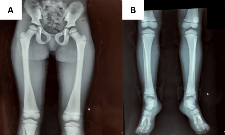 Frontal radiographs of the pelvis and both femora (A) and both legs and feet (B) showing generalised osteosclerosis