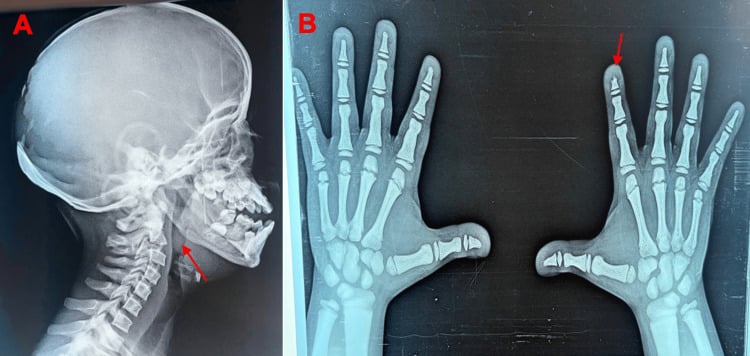 Panel A, lateral skull radiograph with an arrow at the obtuse mandibular angle; panel B, both hands with an arrow at a short distal phalanx