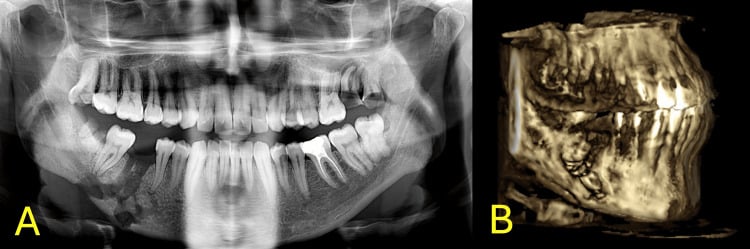 Panel A, preoperative panoramic radiograph with destructive change in the right mandibular body; panel B, three-dimensional CT of the mandible