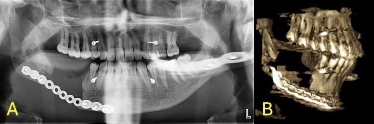 Panel A, postoperative panoramic radiograph with a long reconstruction plate along the right mandible and a second plate on the left; panel B, three-dimensional CT of the plated mandible
